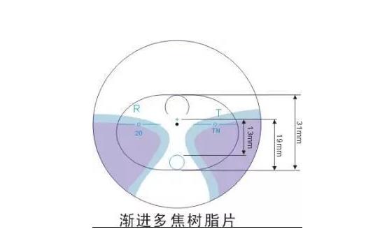 美麗島多焦鏡適合的人群，需要注意的事項(xiàng)