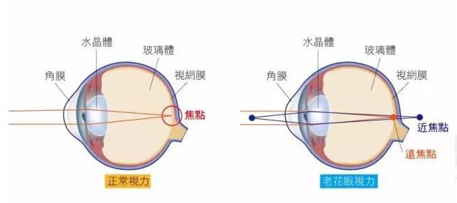500度近視又老花，戴上美麗島多焦鏡煩惱全解決，46歲的周先生樂(lè)壞了
